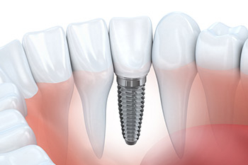 Implant Dentistry 